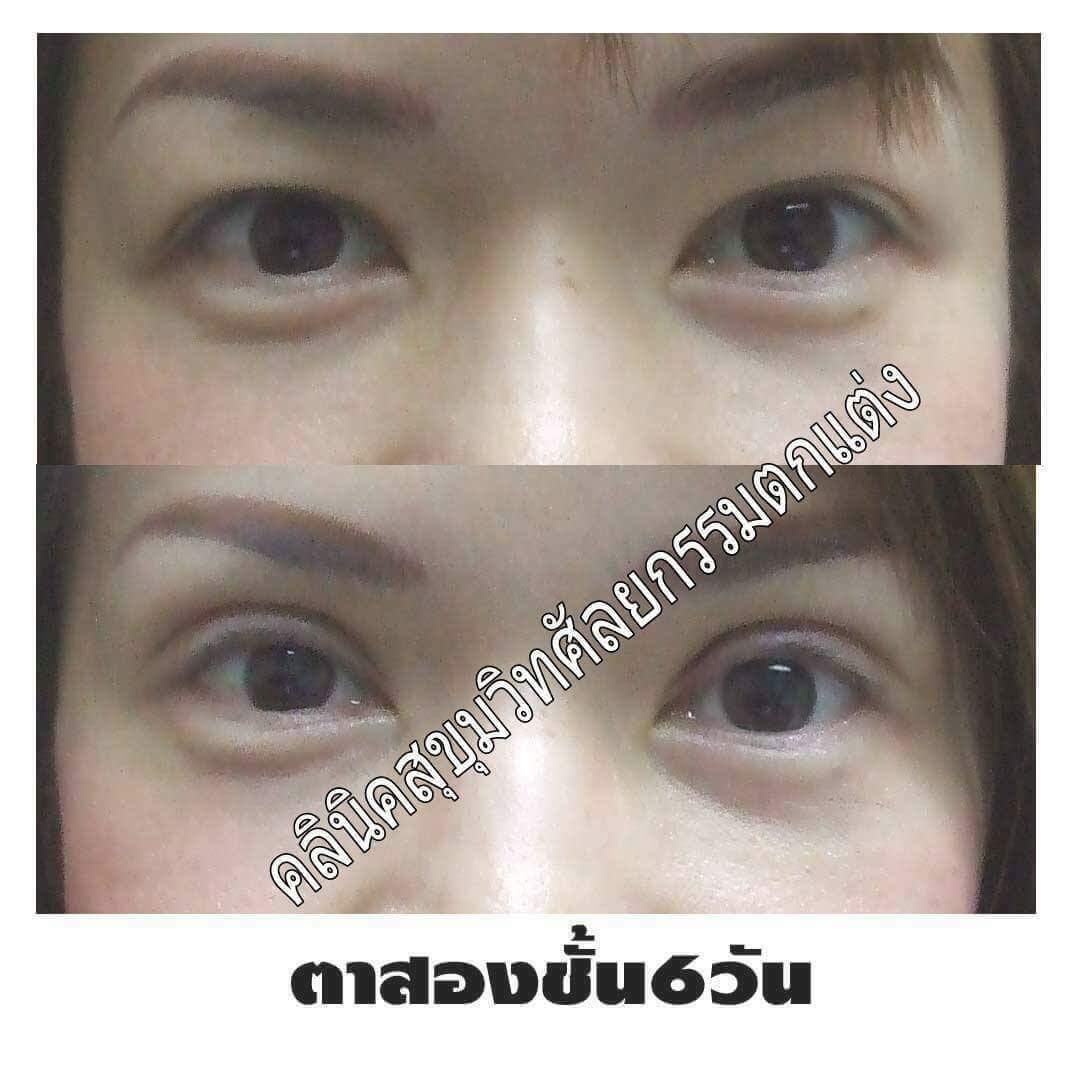 ตาสองชั้นdouble eyelid