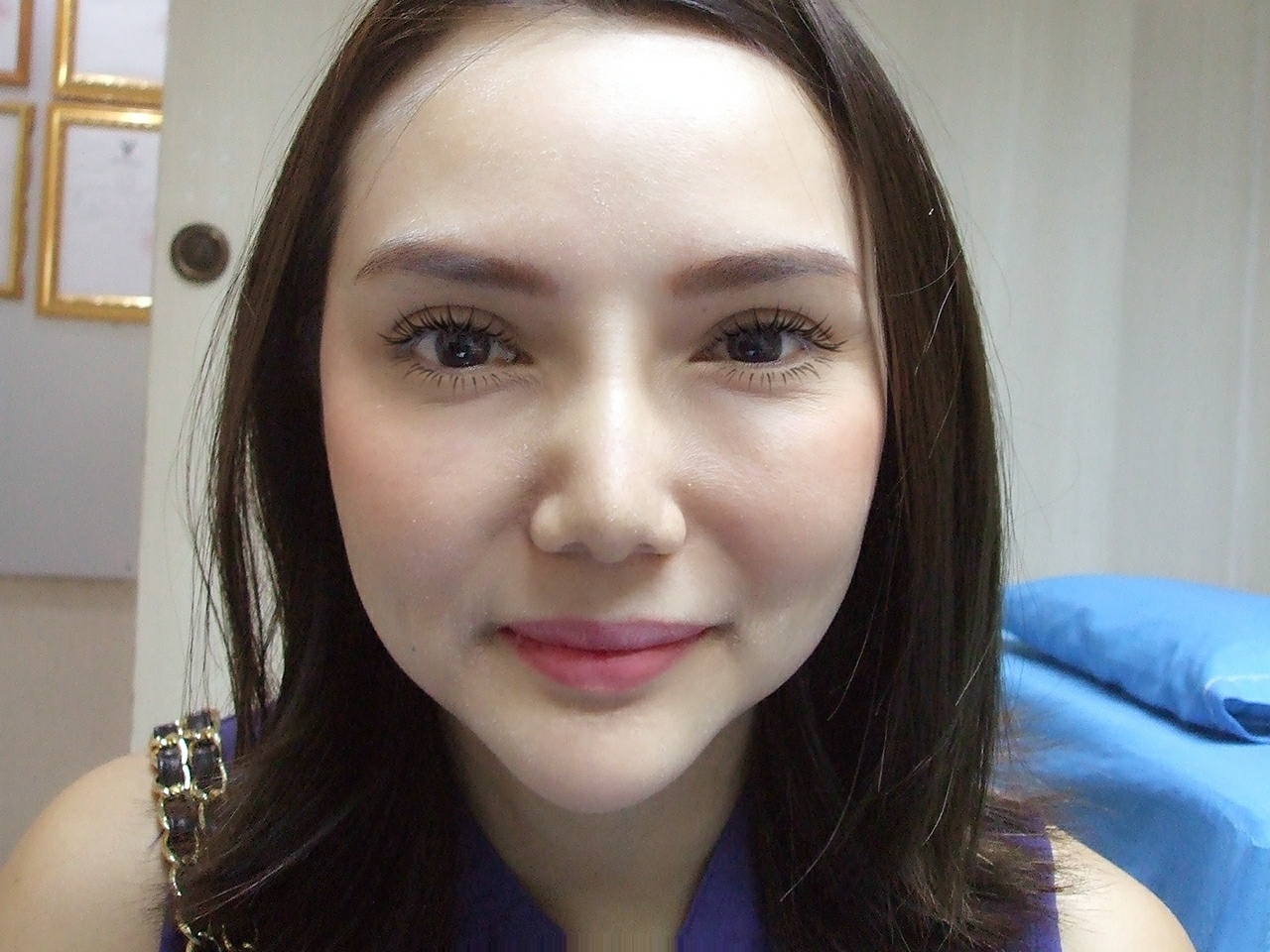 เสริมจมูก
