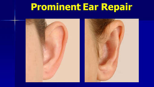 หูกางprominent ear