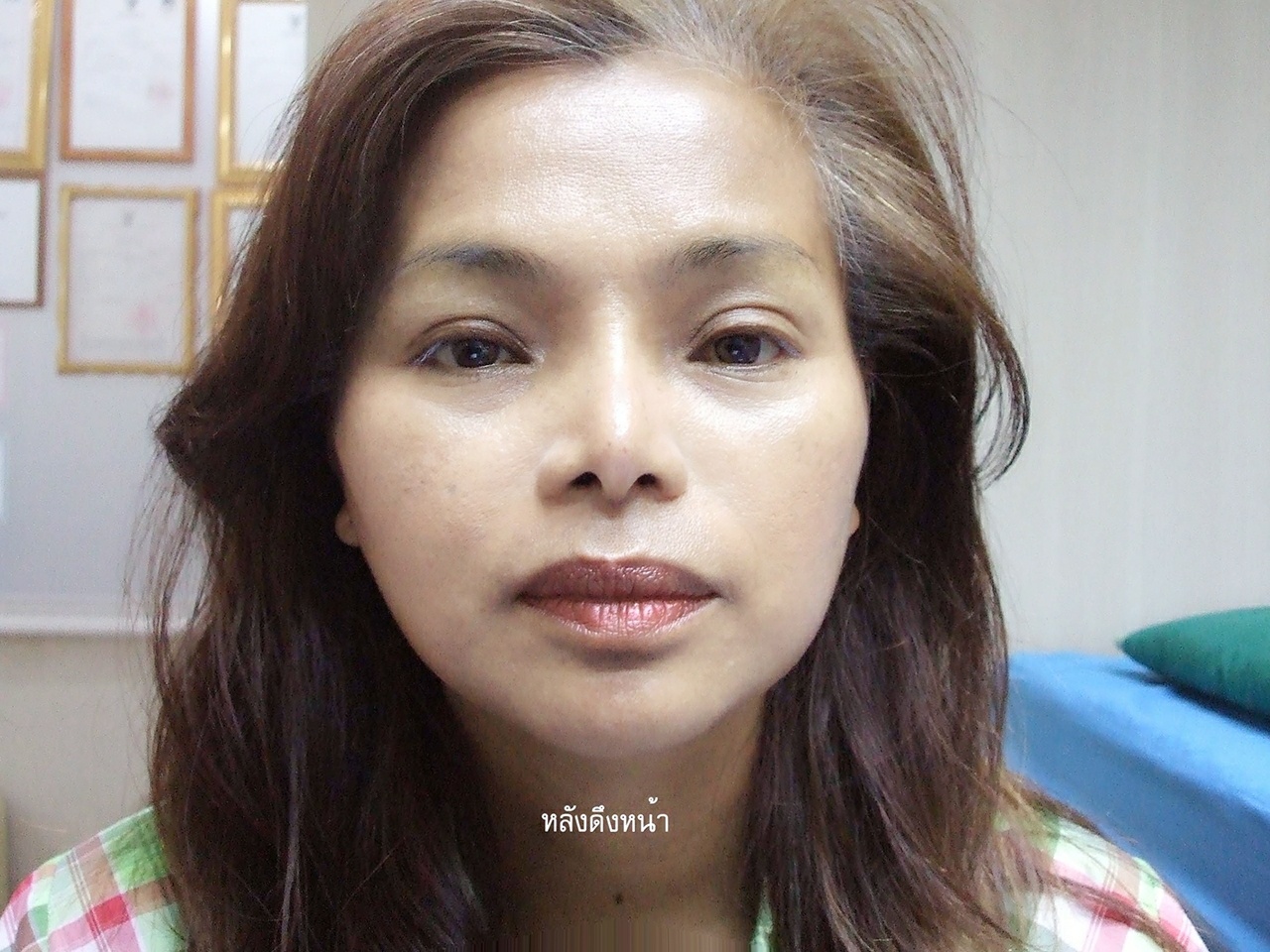 หลังดึงหน้า