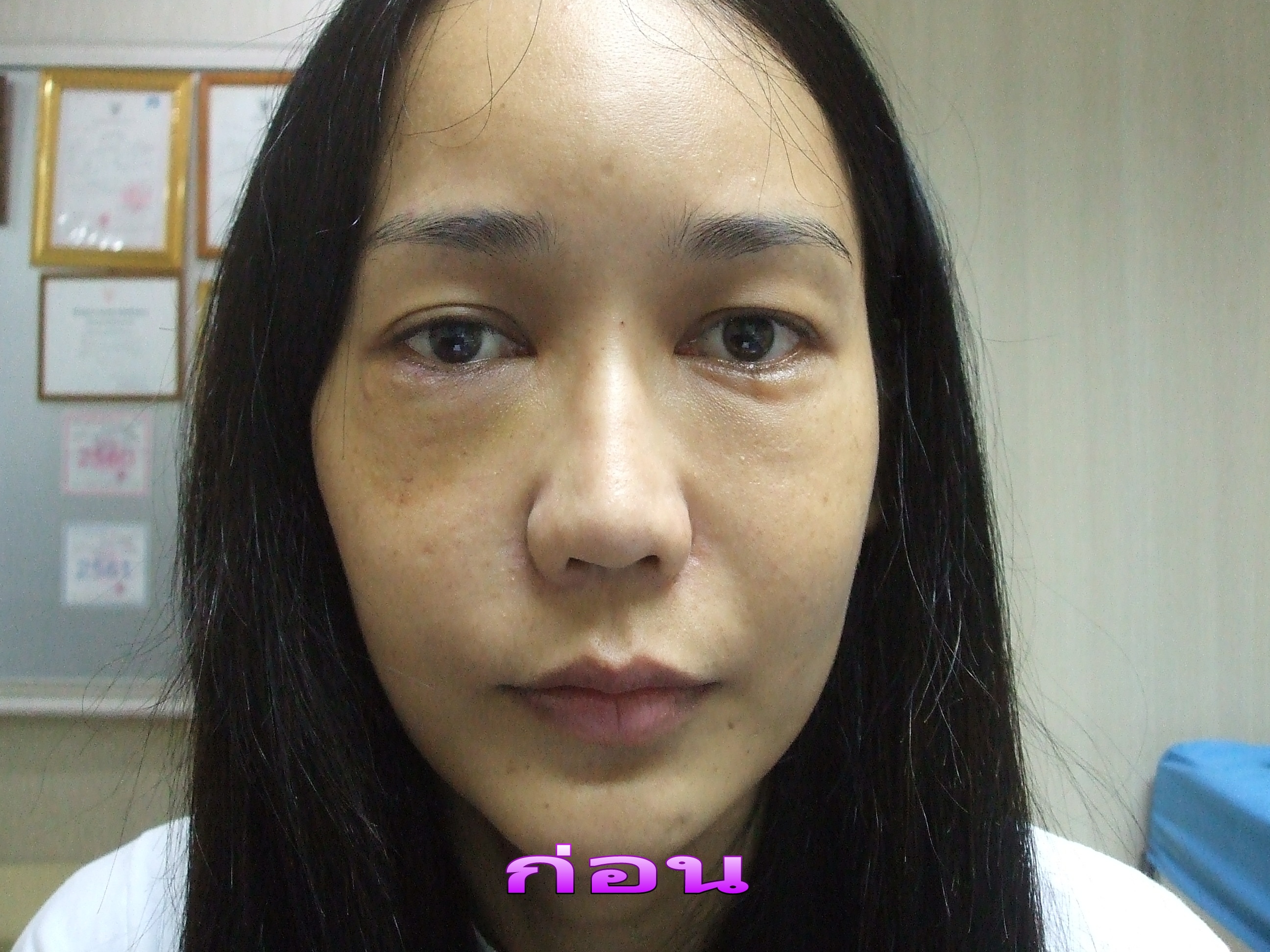 แก้ไขตาบนตาล่างจากฉีดและทำจากที่อื่น
