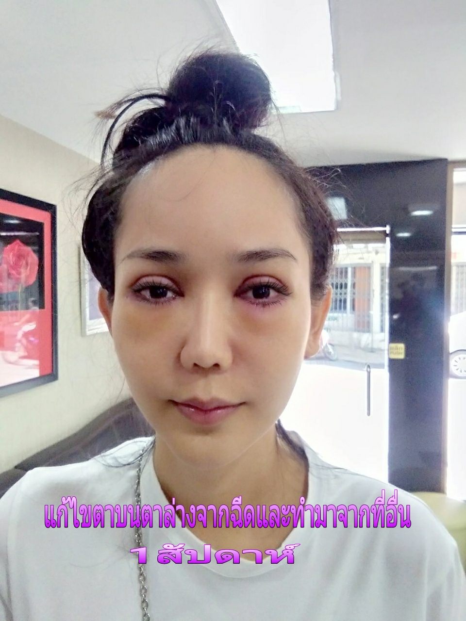 แก้ไขตาบนตาล่างจากฉีดและทำจากที่อื่น