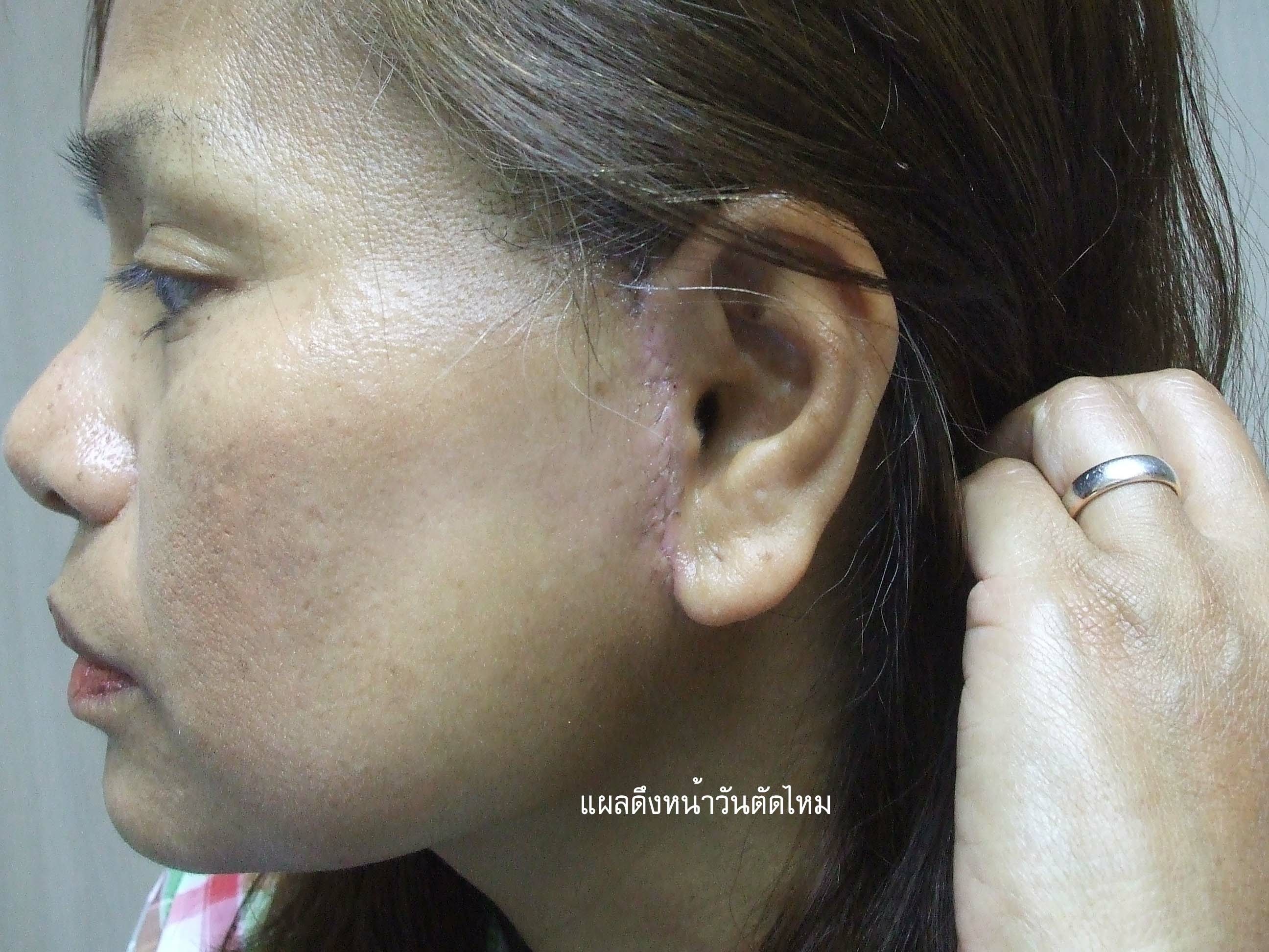 แผลดึงหน้า7วัน