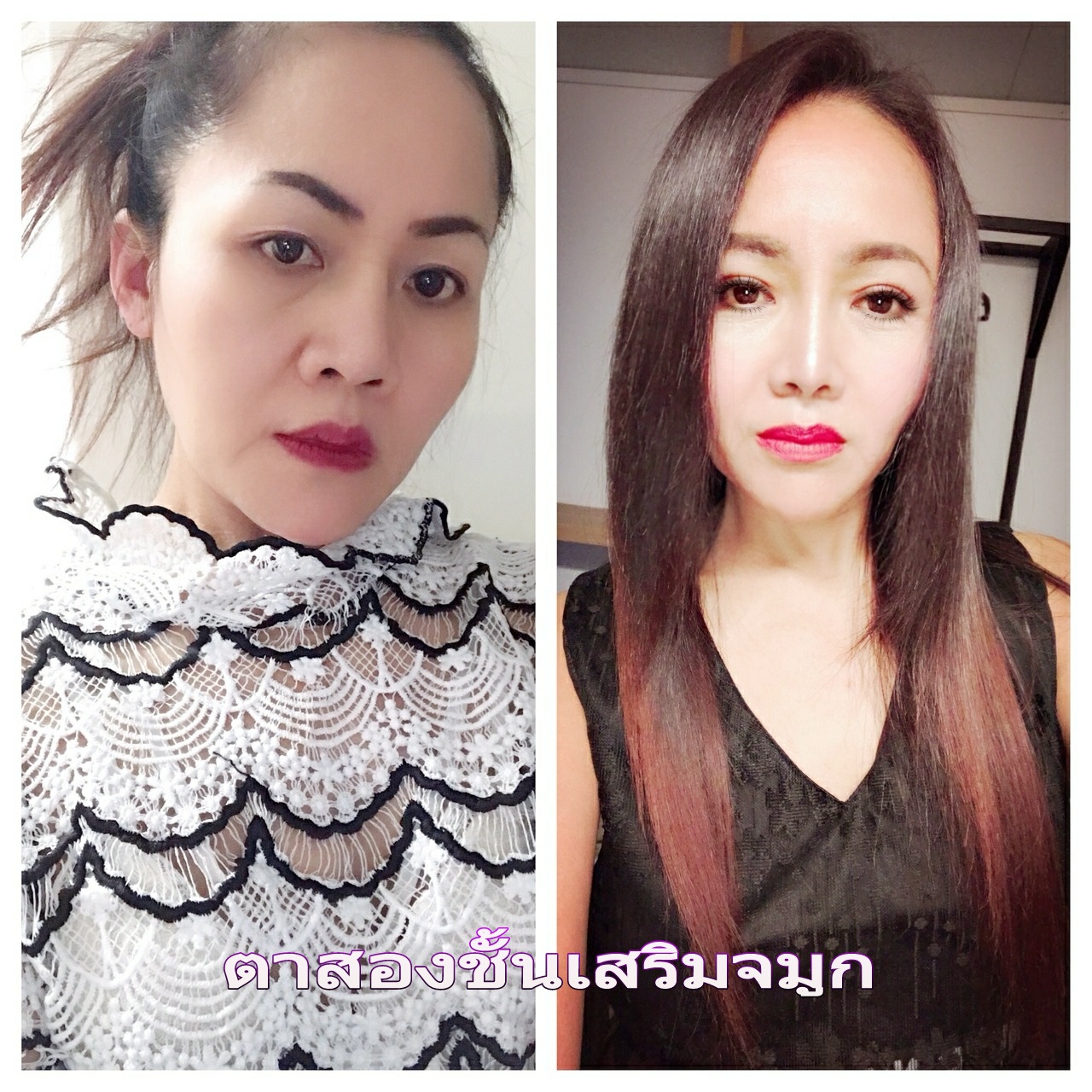 เสริมจมูก ตาสองชั้น