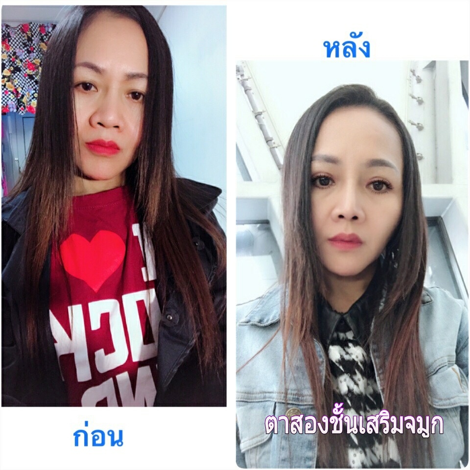 เสริมจมูกตาสองชั้น