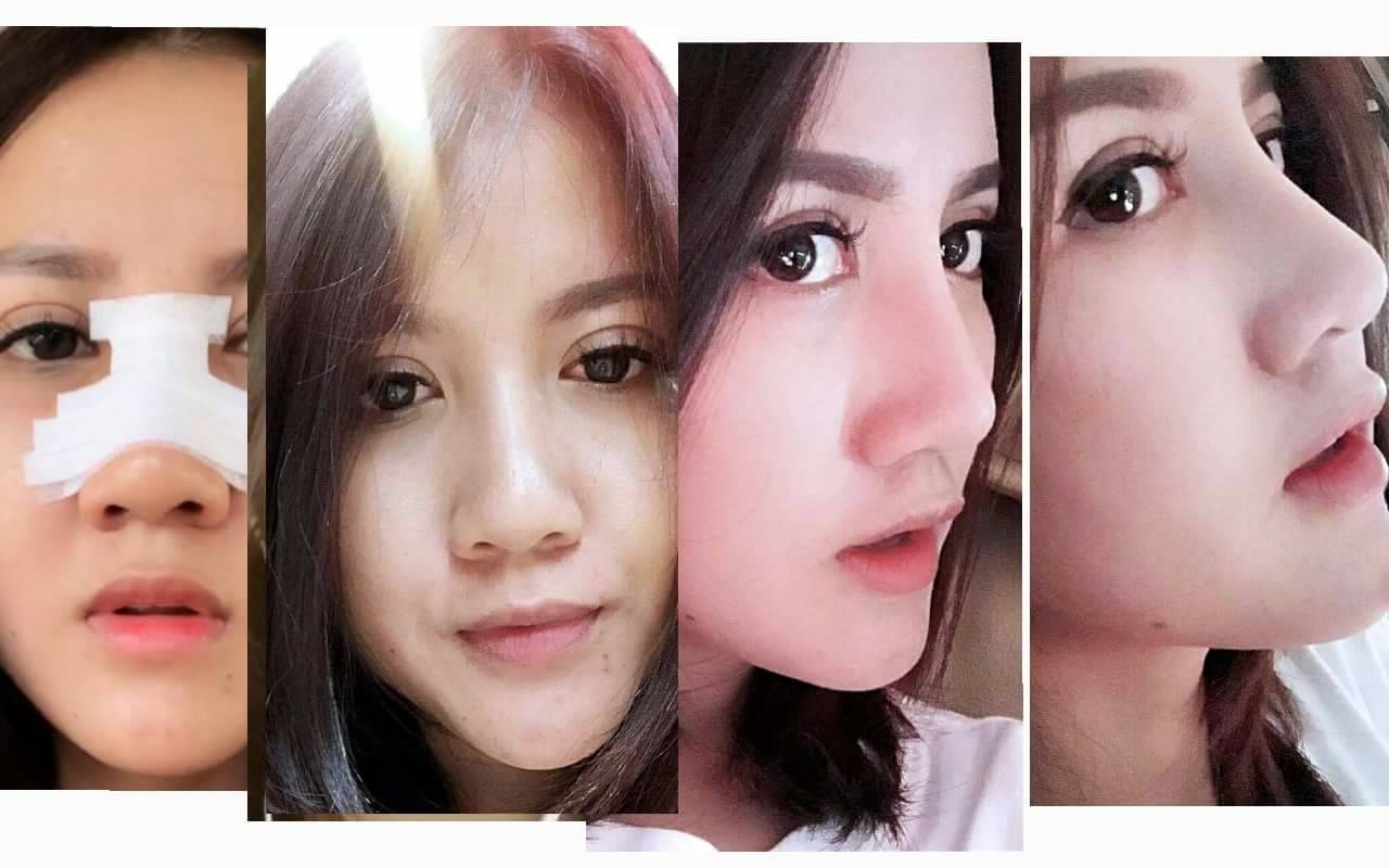 เสริมจมูก