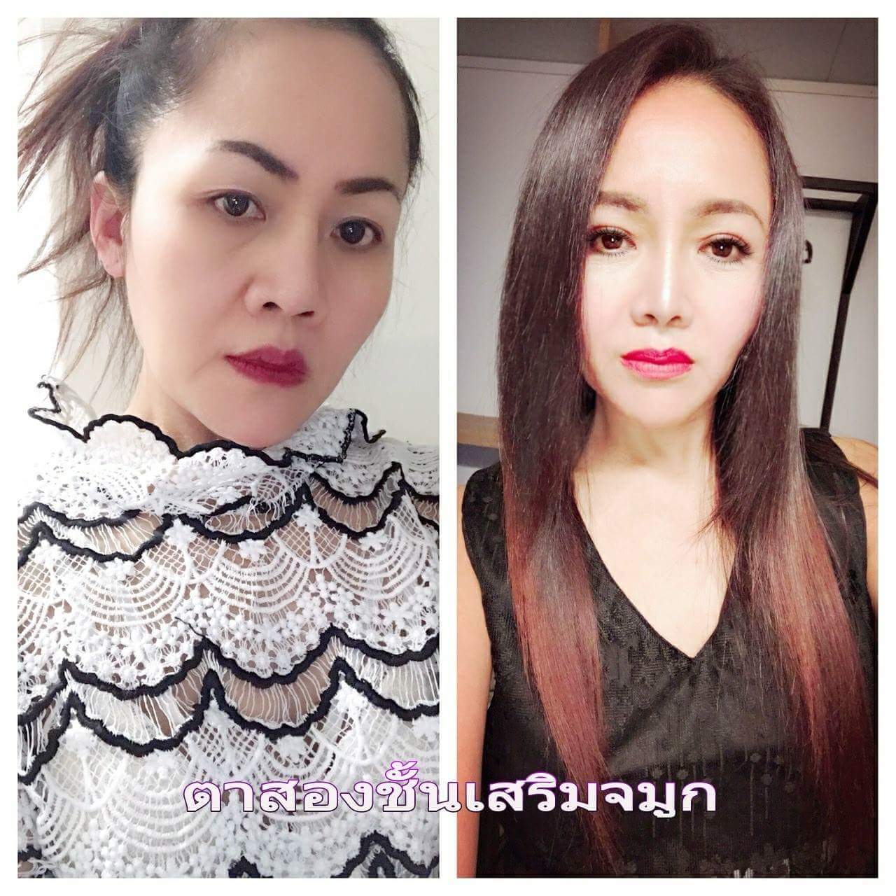 ตาสองชั้นและเสริมจมูก