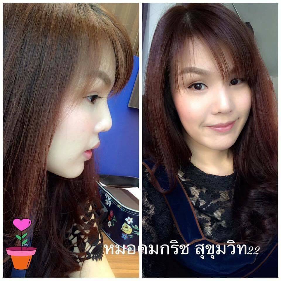 เสริมจมูก