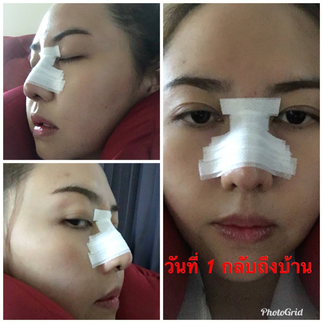 เสริมจมูก