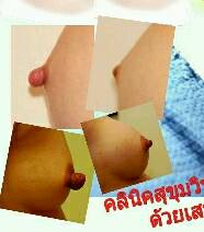 ลดขนาดหัวนม