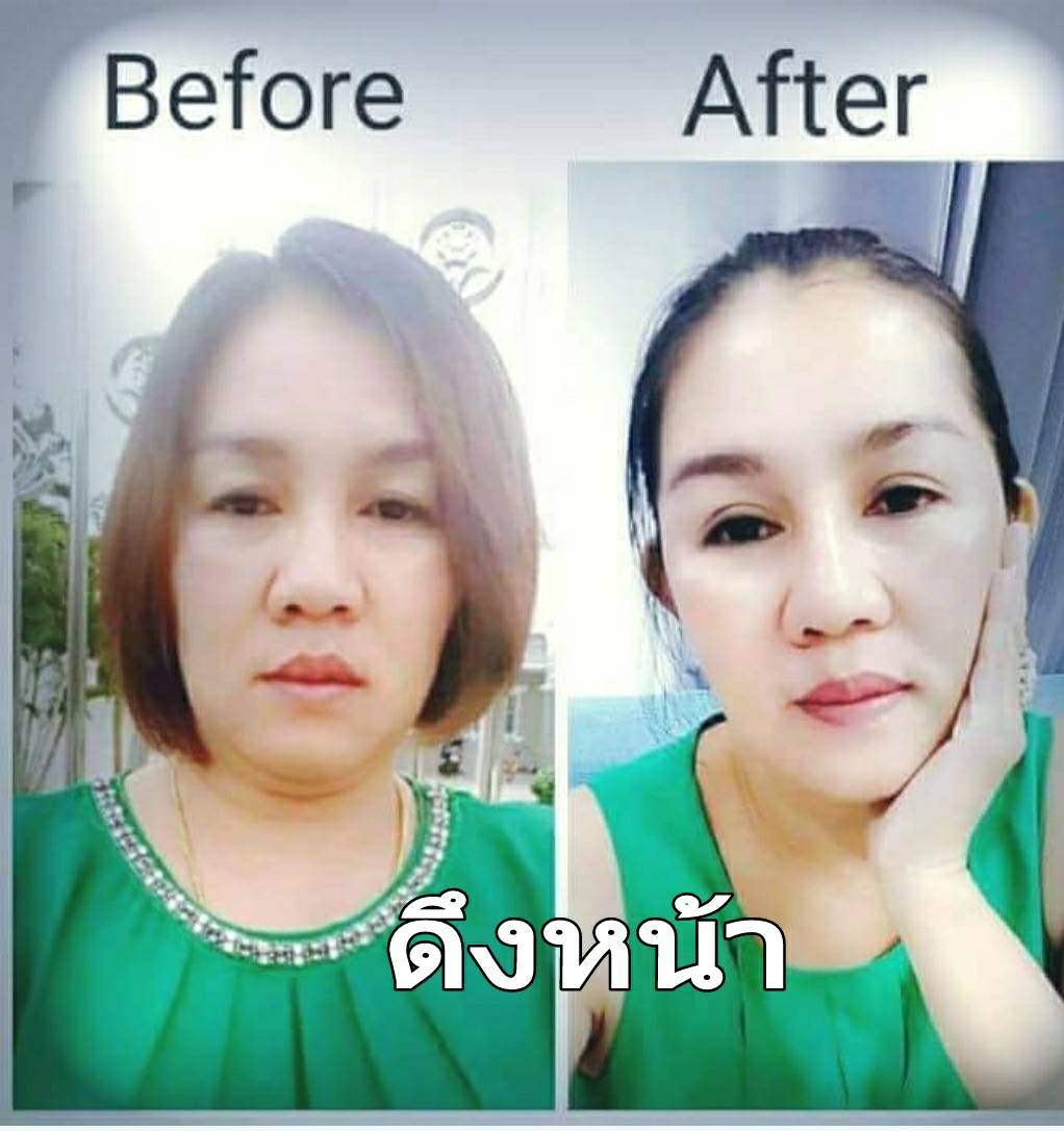 ดึงหน้า (Full Facelift)