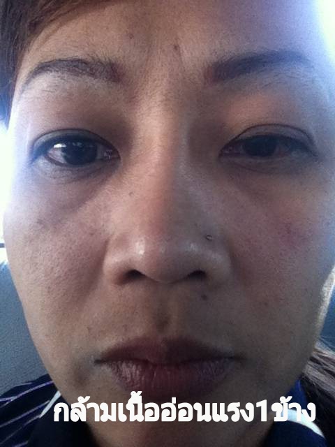 หนังตาตก