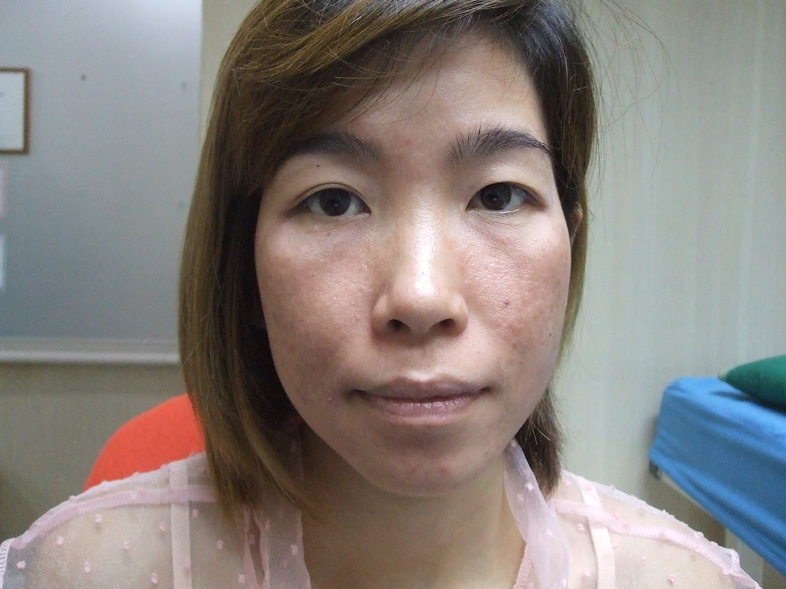 เสริมจมูก ตาสองชั้น