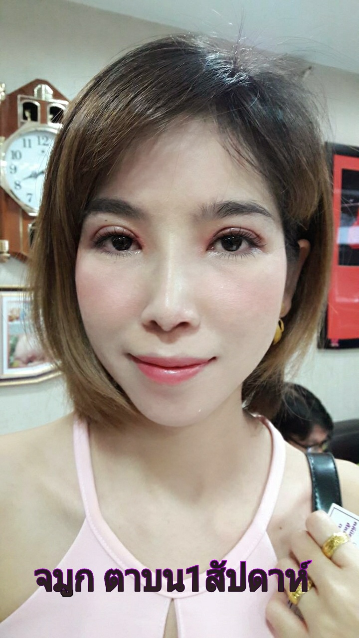 เสริมจมูก ตาสองชั้น