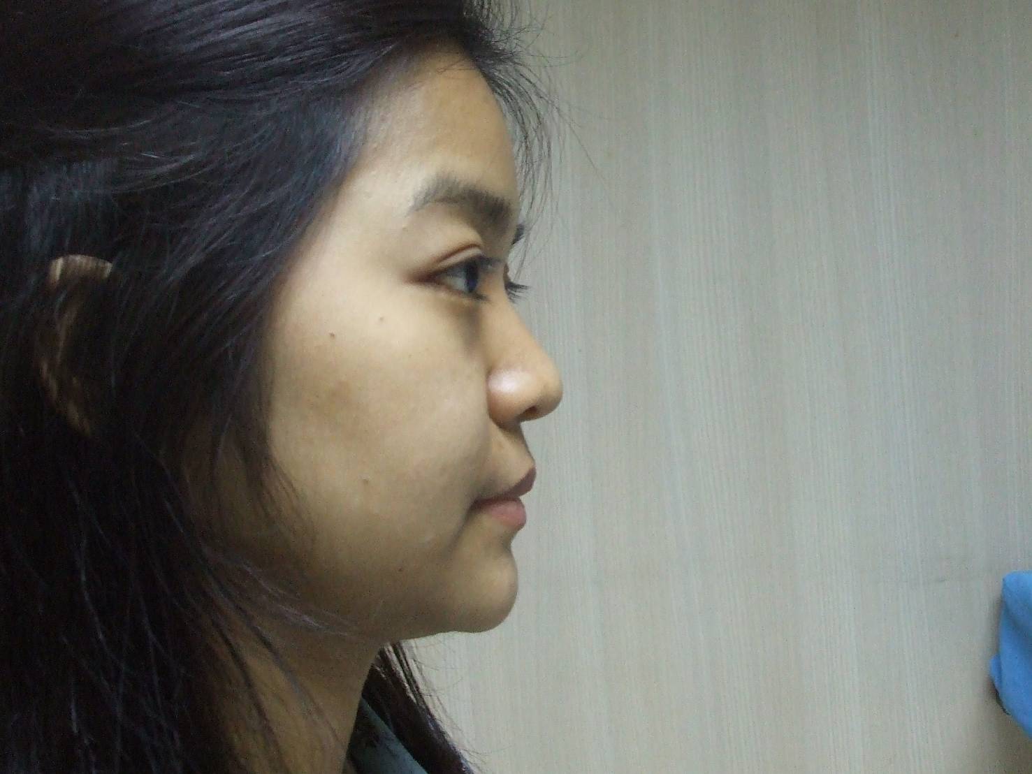 ก่อนเสริมจมูก