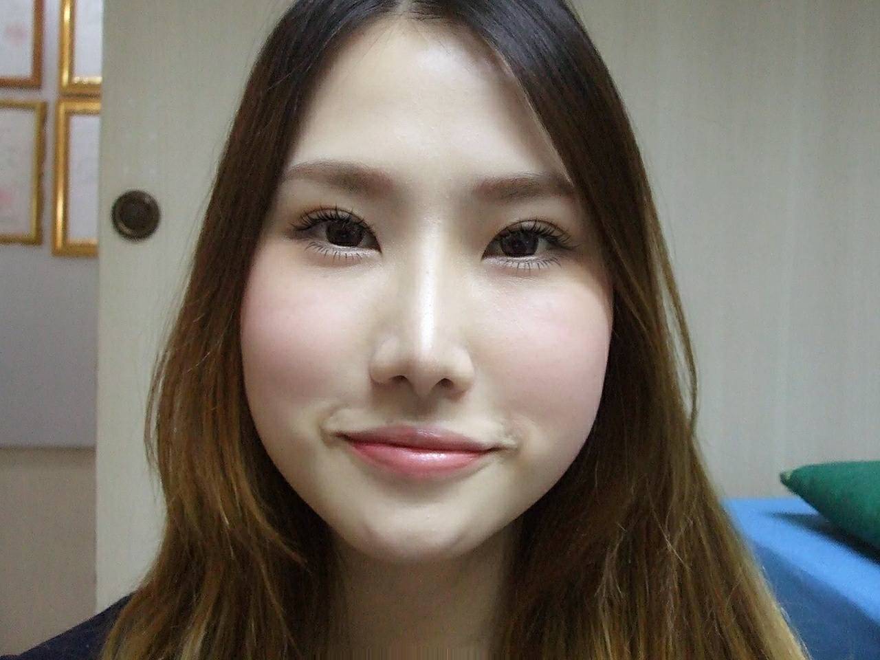 เสริมจมูก