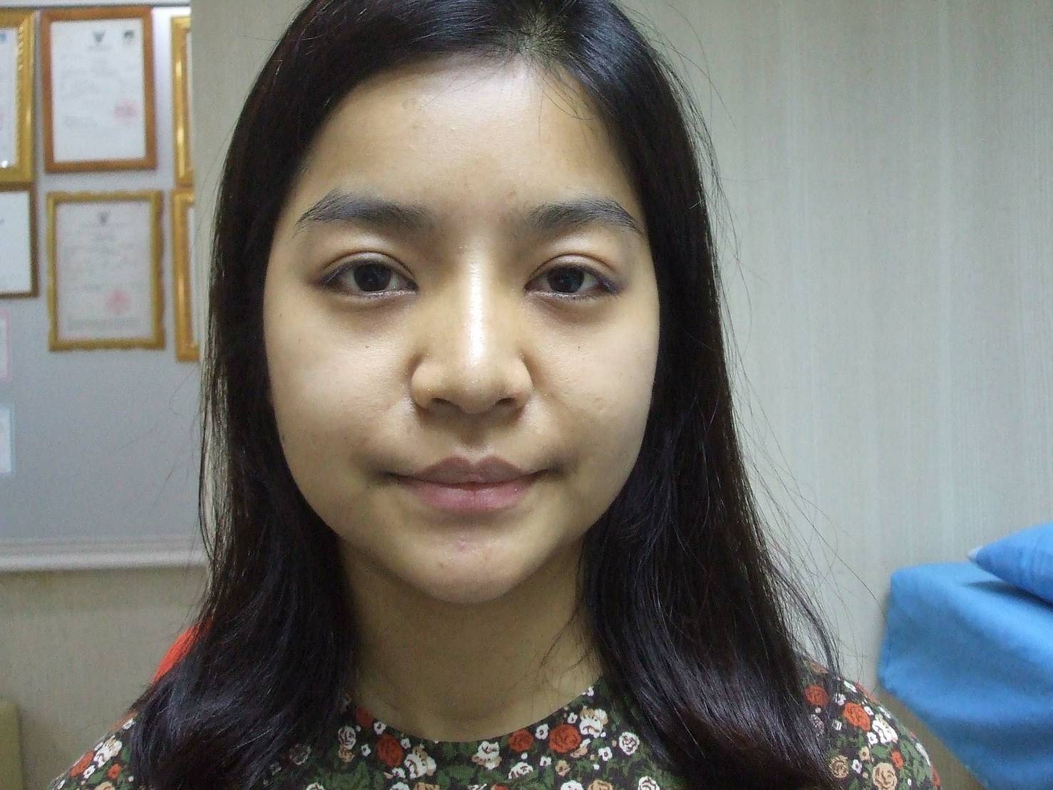 หลังเสริมจมูก