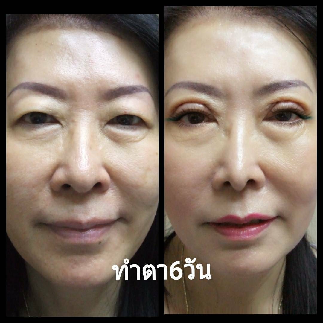 หลังทำตาสองชั้น 6 วัน