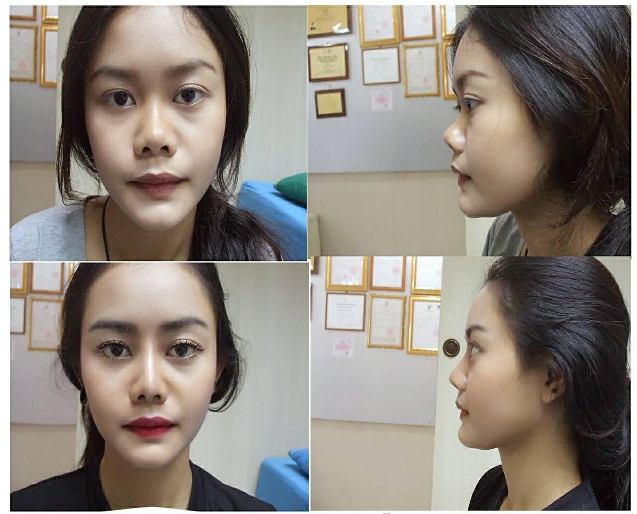 เสริมจมูก