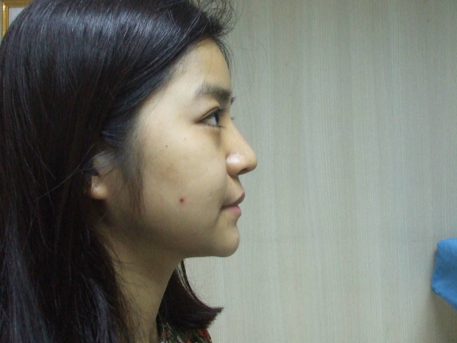 หลังเสริมจมูก