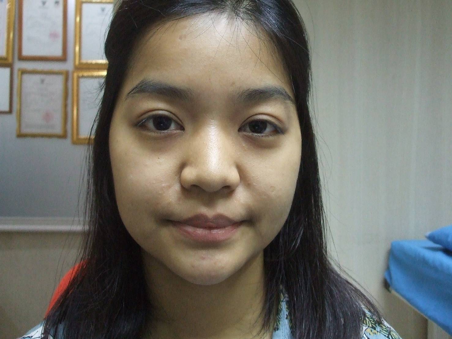 ก่อนเสริมจมูก