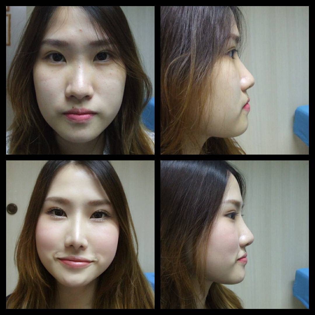 เสริมจมูก